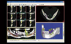 治療計画システム simplantによる診断