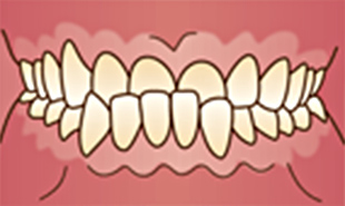 下顎前突（受け口）
